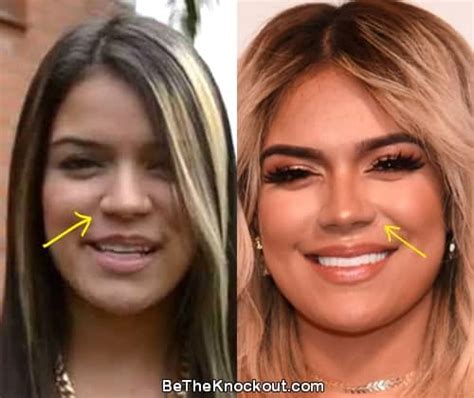 karol g nose job|Karol G: Before and After Plastic Surgery